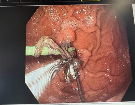 Gastric Electrical Stimulator secondary