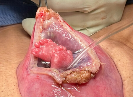 Feet sticking out of fetal procedure