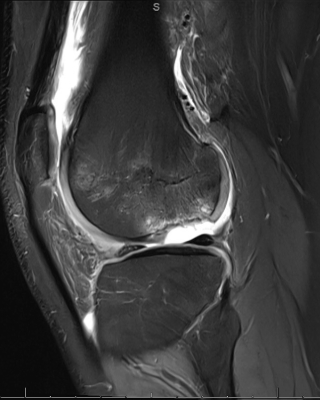 MRI with injury