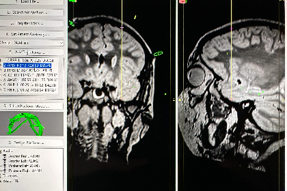 APH Refractory Epilepsy 1 web