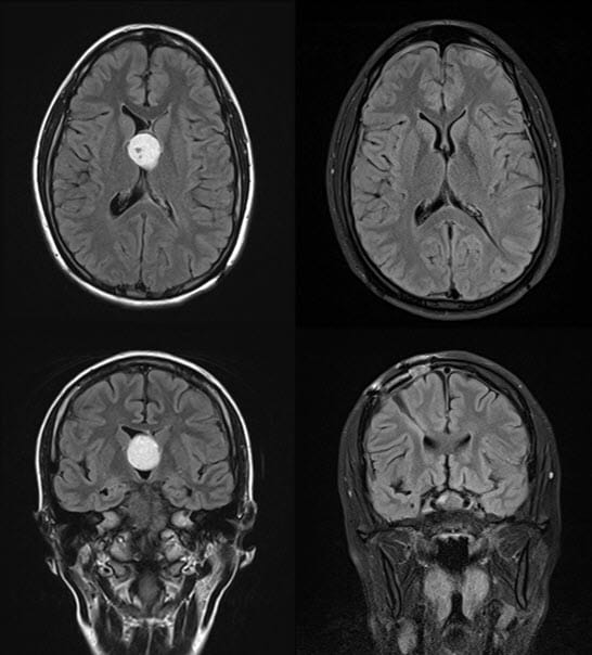 Endoscopic Brain Surgery 1 web