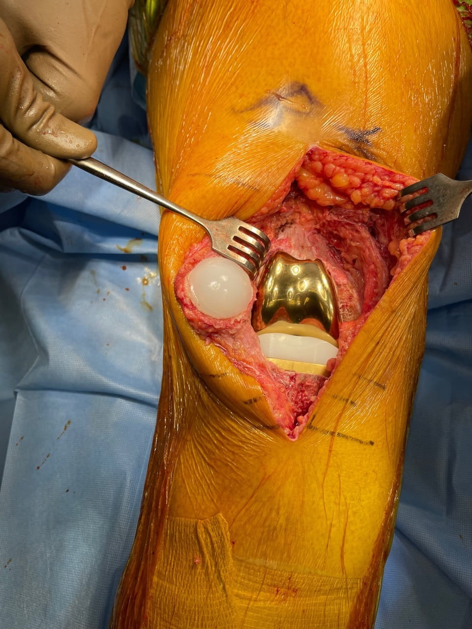 Gold Knee Implant 2 web