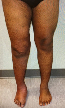 Lymphedema 1 web