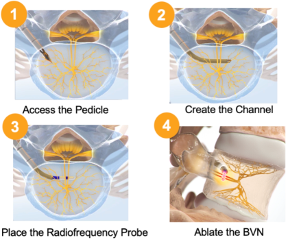 Novel Basivertebral Nerve 1 web