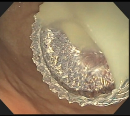 Pancreatitis Research Study 2 web