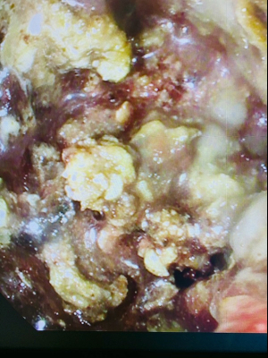 Pancreatitis Research Study 3 web