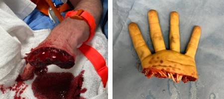 Replanted hand 1