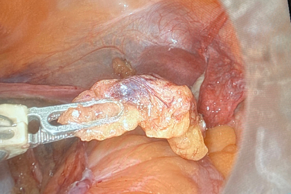 Two Novel Procedures gynecologic Cancer Patients web