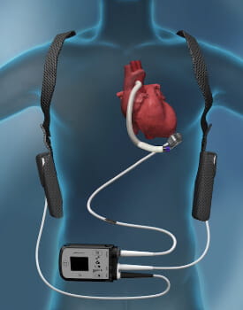LVAD Option 2