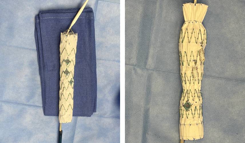 Customized Fenestrated-Branched Endovascular Repairs 1