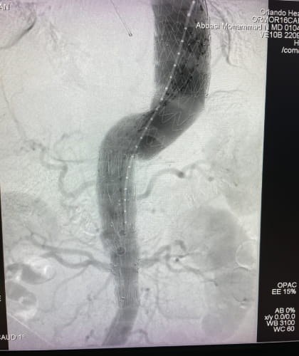 Customized Fenestrated-Branched Endovascular Repairs 3