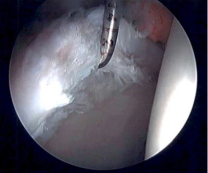 Hip Preservation Surgery 1