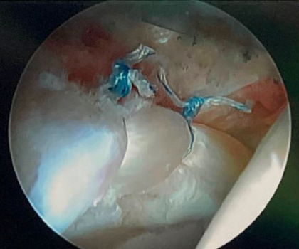 Hip Preservation Surgery 2