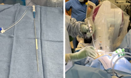 Laser Interstitial Thermal Therapy 1