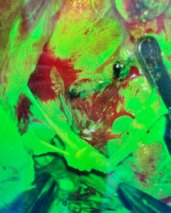 Microsurgeons Improve Sensory Recovery in Breast Cancer Patients 2