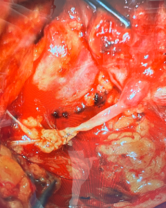 Microsurgeons Improve Sensory Recovery in Breast Cancer Patients 1
