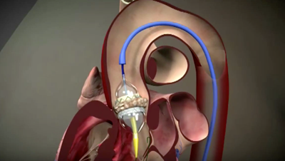 Transcatheter aortic valve replacement surgery.