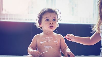 Baby with measles