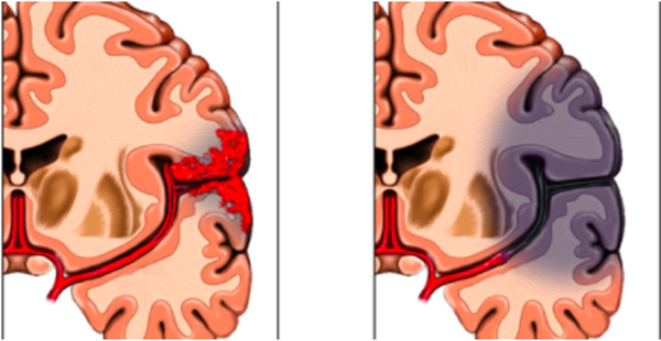 Image of a brain that has experienced a stroke.