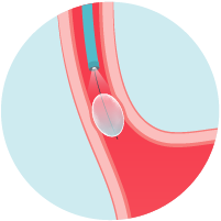 Inflation of the balloon causes the narrowed area to stretch and re-expand.