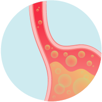 Acid Reflux with a weak lower esophageal sphincter.