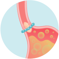 LINX system expands to allow for normal swolling.