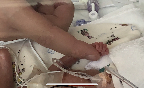 Micropremie is Tiniest Baby to Ever Graduate from NICU
