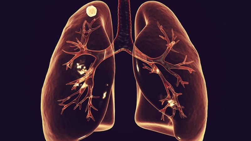 What Are Lung Nodules?