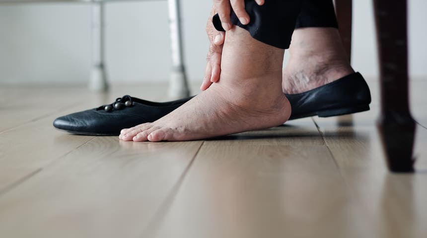 President Trump’s Chronic Venous Insufficiency Diagnosis Common for Older Americans