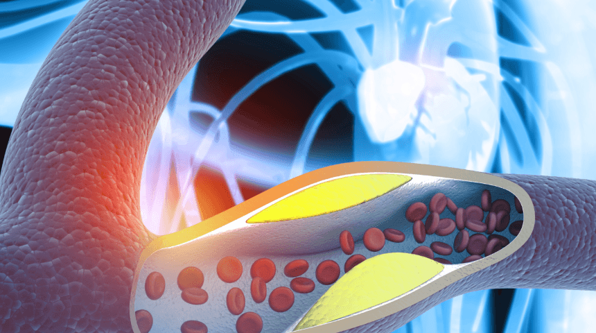 New Cholesterol Guidelines: Why You Need to Lower Your LDL Levels Sooner