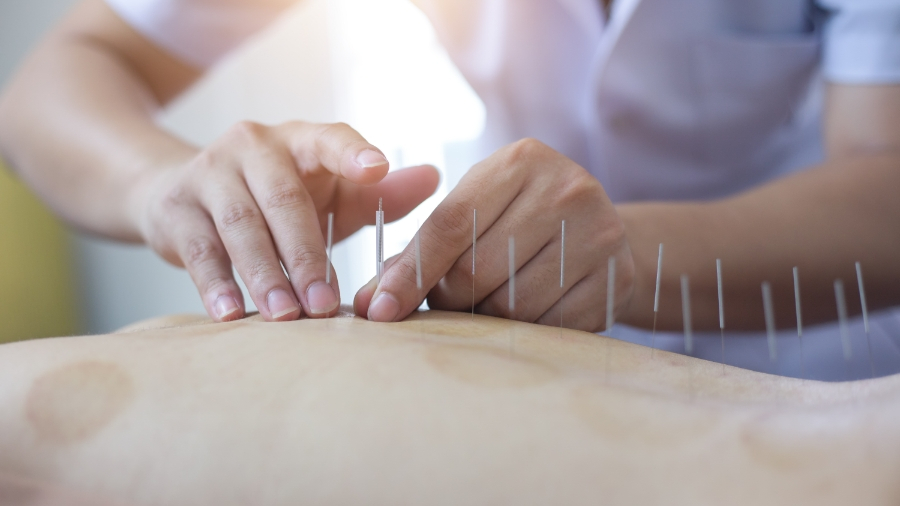 Common Questions About Acupuncture 
