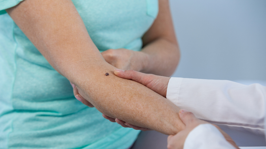 Skin Cancer—Early Prevention, Early Detection