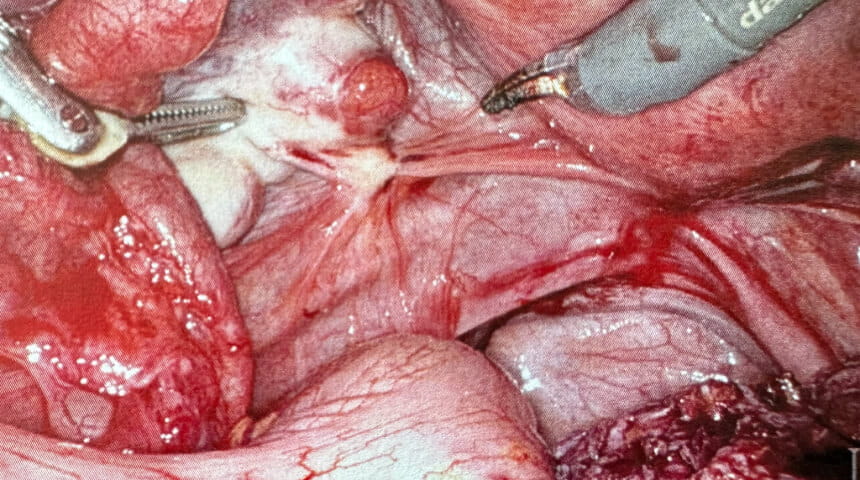 Multidisciplinary Tandem Surgeries Address Aggressive Deep Infiltrative Endometriosis