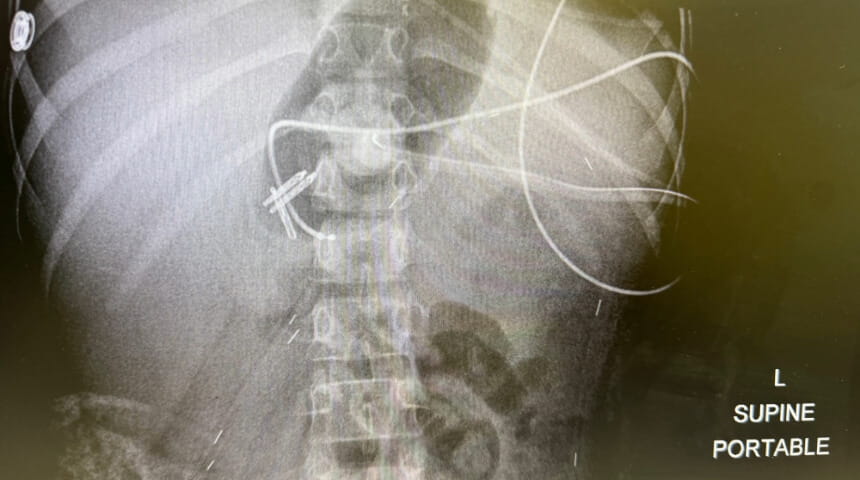 Gastric Electrical Stimulator Placement Resolves Severe Feeding Intolerance in Pediatric Patients