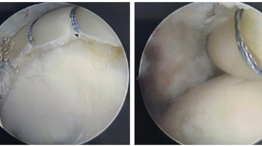Complex, Minimally Invasive Labral Reconstruction Restores Hip Mobility