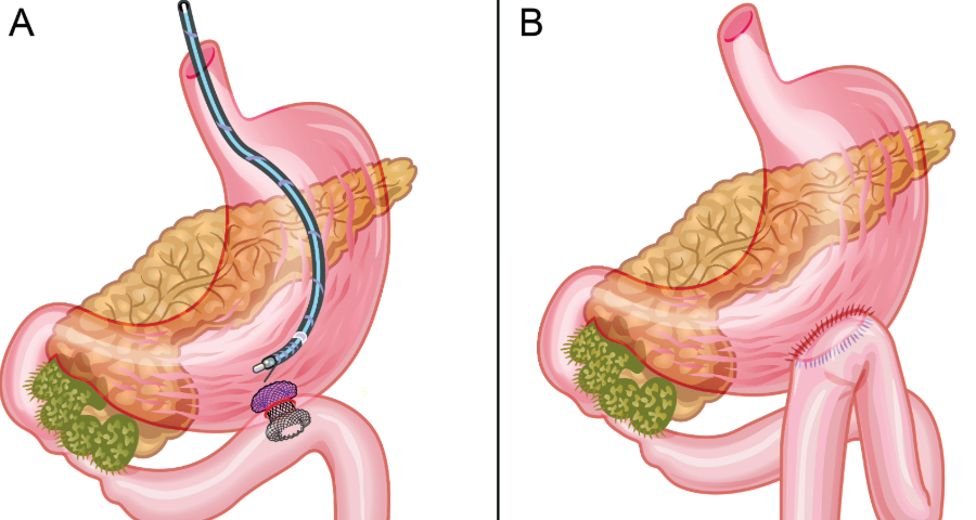 Collaborative International Research Evaluates Important Treatment Approach for Pancreatic Cancer