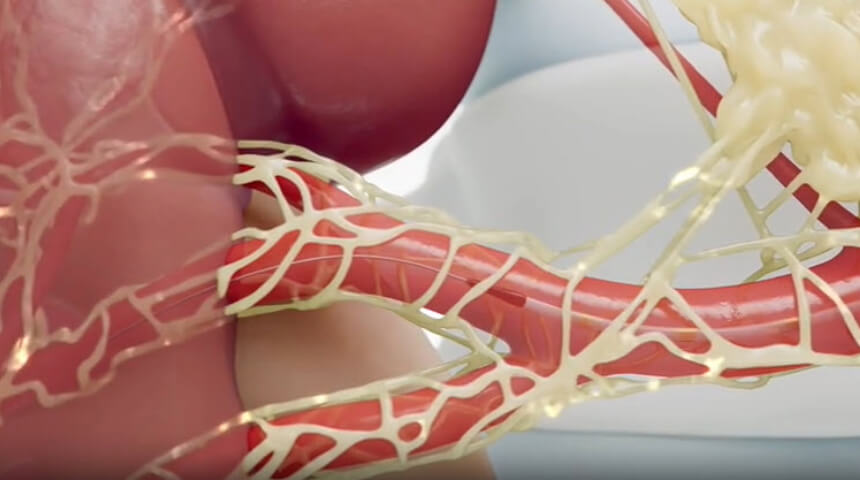 FDA-Approved Renal Denervation Benefits Patients with Resistant Hypertension