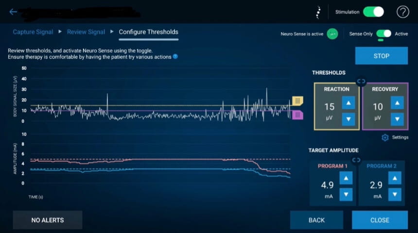 Novel Closed Loop Spinal Cord Stimulator Advances Personalized Pain Management
