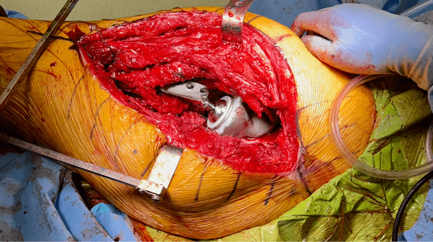 Mixed-Reality Surgical System Enhances Precision, Outcomes for Complex Hip Replacement