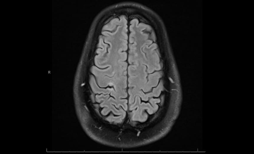 Comprehensive Protocols Improve Quality of Life for MS Patients