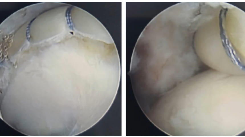 Complex, Minimally Invasive Labral Reconstruction Restores Hip Mobility