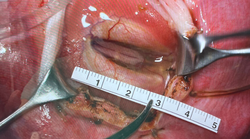 Complex Open Fetal Procedures Deliver Advanced Care for High-Risk Pregnancies