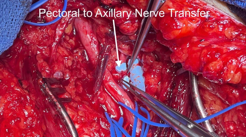 A Novel Approach to Treating Complex Brachial Plexus Injuries