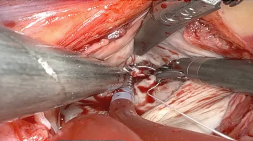 Robotic Cardiac Surgery Program Launches for Valvular Repair