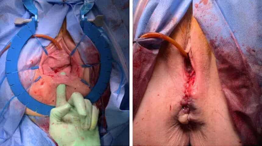 Urogynecology Team Offers Advanced Solutions for Prolapse and Fistula Repairs