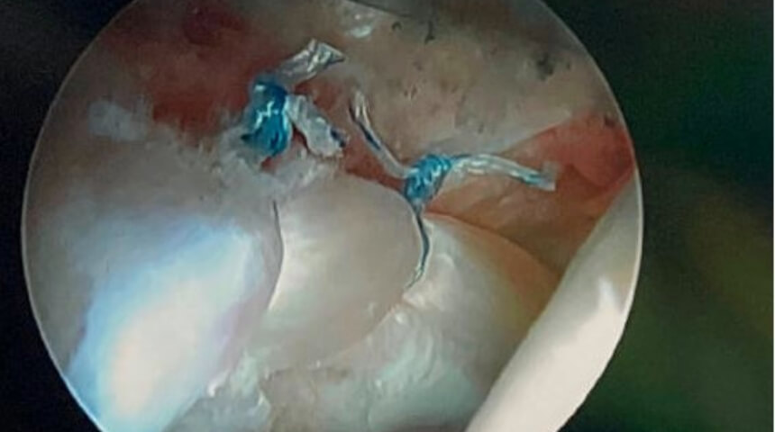 Hip Preservation Surgery Can Reduce Future Arthritis, Replacement Risks in Select Patient Populations