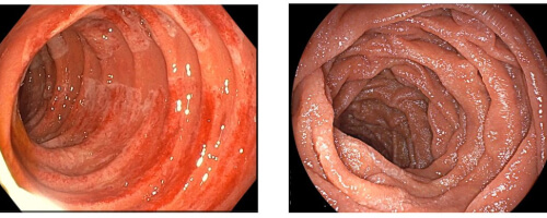 Duodenal Mucosal Resurfacing Analyzed as Type 2 Diabetes Treatment in Pivotal Study