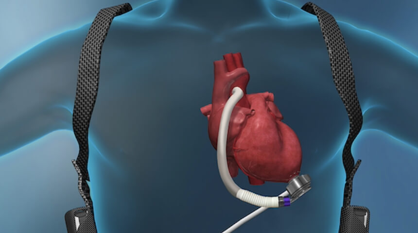LVAD Option Added to Comprehensive Treatments for Heart Failure