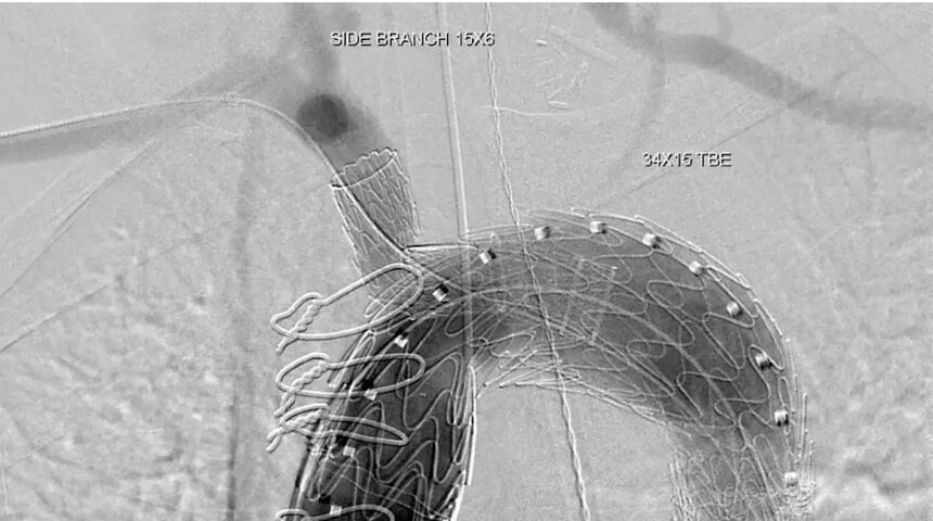 Novel Thoracic Branch Endoprosthesis Expands Options for Complex Endovascular Lesions