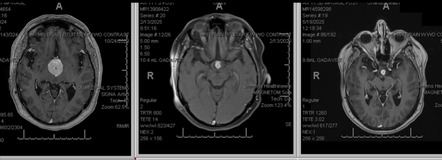 New Therapy Effectively Shrinks Craniopharyngioma Brain Tumors